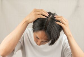 AGA(男性型脱毛症)のよくある質問